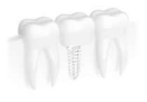 implantes dentales