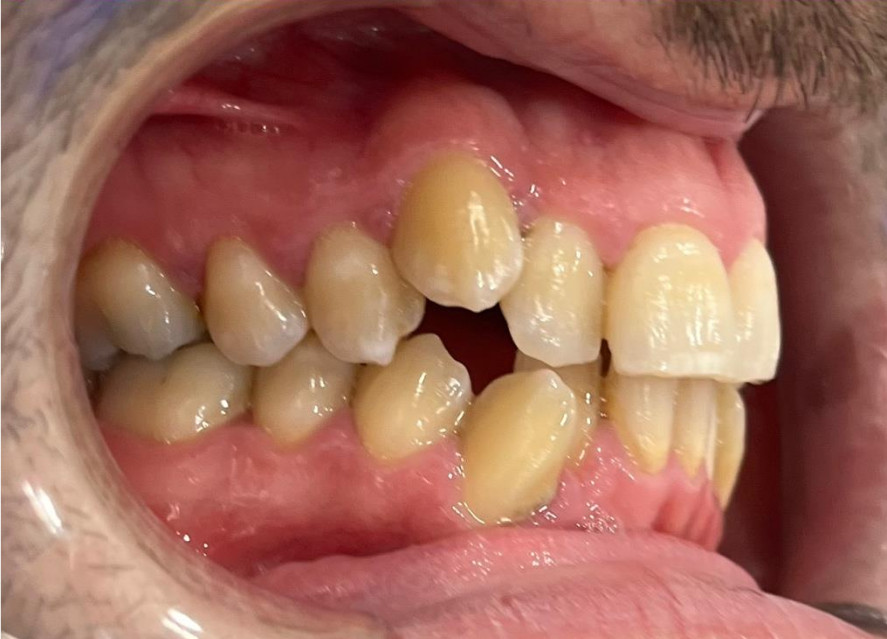 Antes ortodoncia invisible