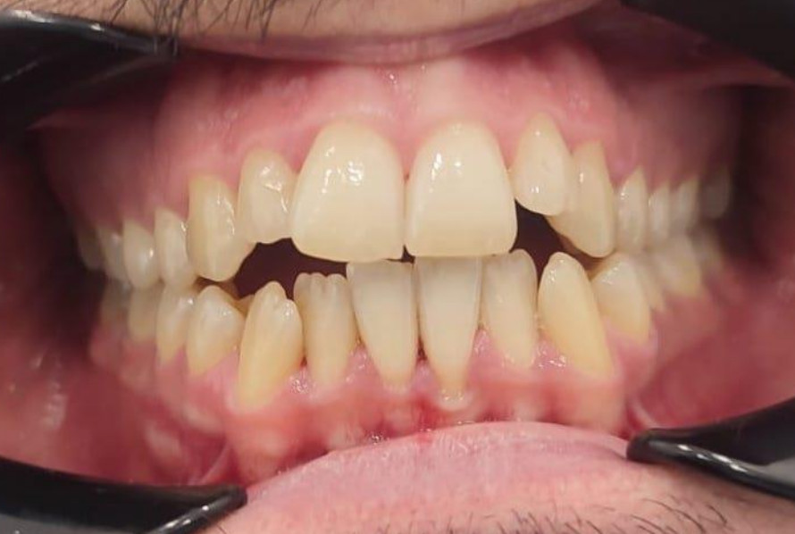 Antes tratamiento seguro