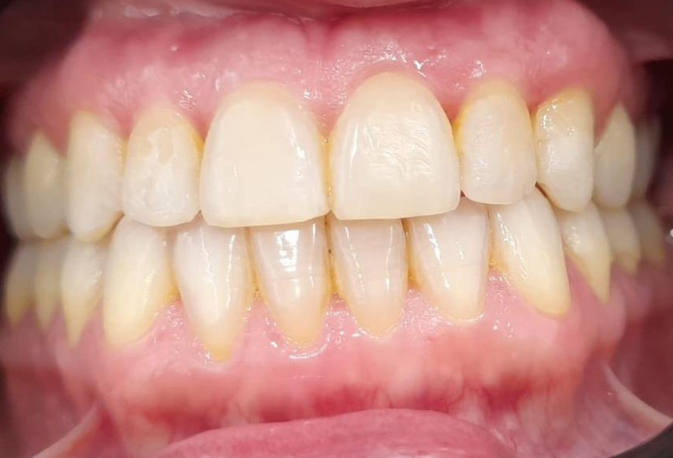 Después tratamiento sin molestias