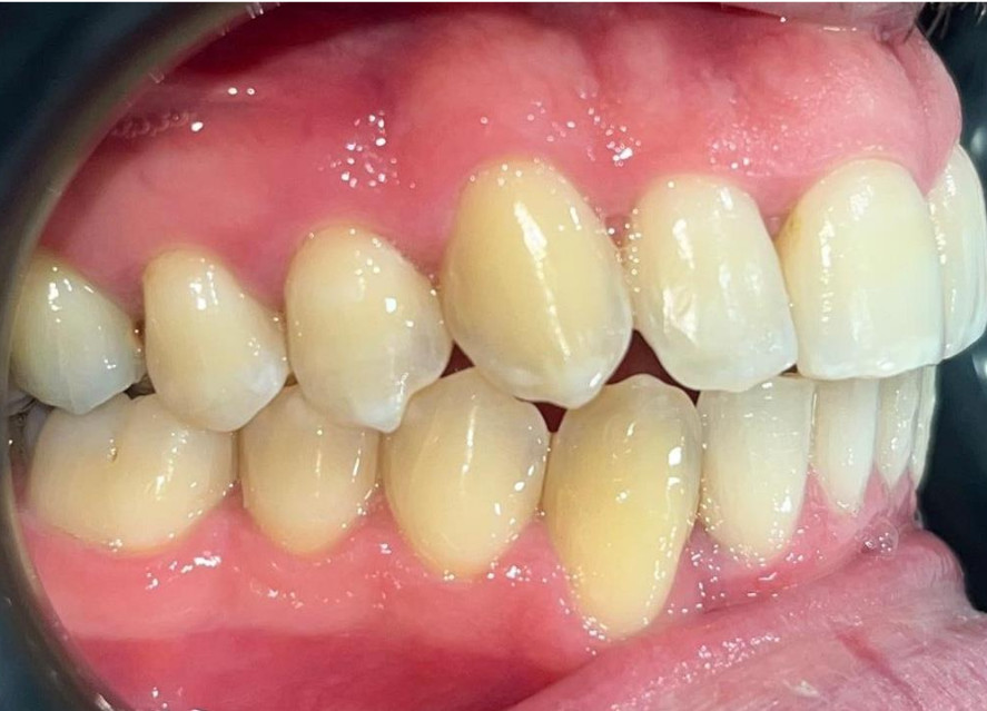 Después ortodoncia invisible