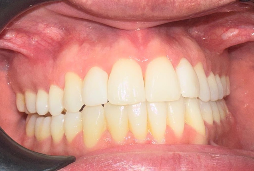 Después tratamiento seguro