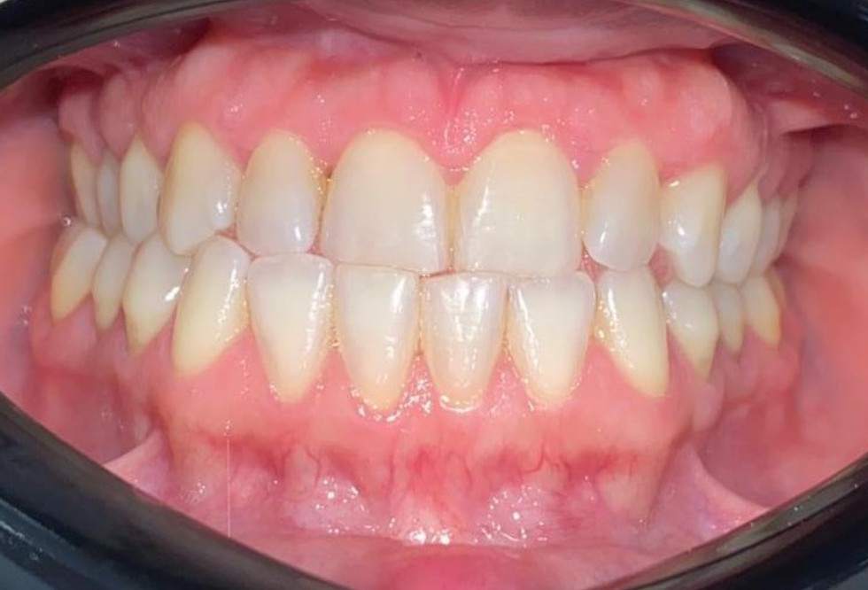 Antes tratamiento sin molestias